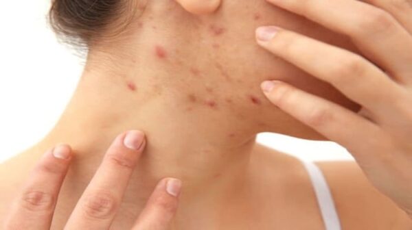 Psoriasi, chi ne soffre si ammala più di tumore