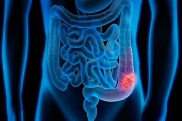 Tumore al colon: i sintomi da non sottovalutare che possono salvarti la vita