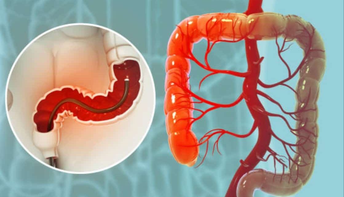 Addio esami invasivi: la colonscopia rivoluzionata da una nuova metodica