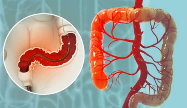 Addio esami invasivi: la colonscopia rivoluzionata da una nuova metodica