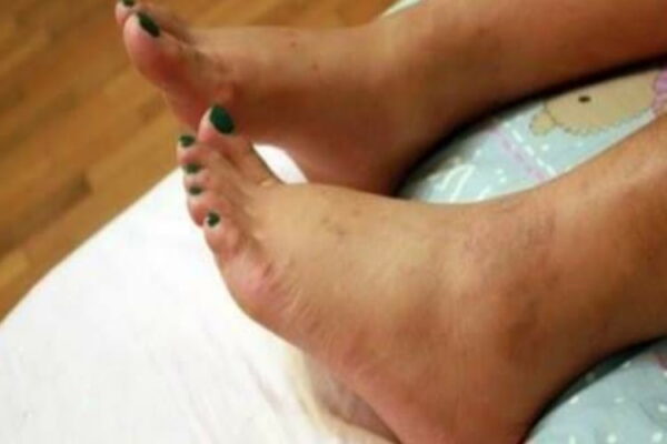 Caviglie gonfie eliminare il problema con i rimedi naturali