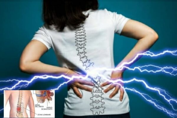 Ernia discale lombare