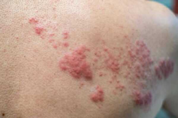 Fuoco di Sant'Antonio scopri i sintomi le cause