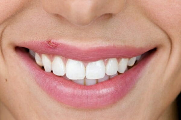 Herpes labiale come sbarazzarsi dell'infezione in una sola notte