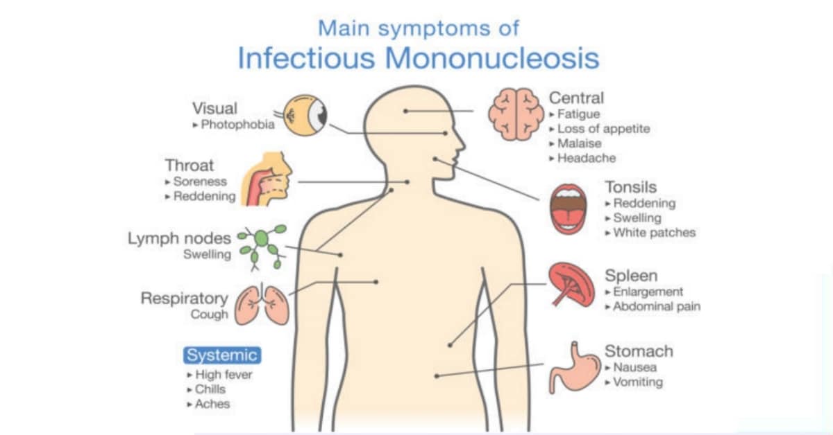 La mononucleosi spesso chiamata malattia del bacio