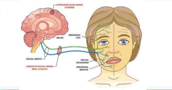 Le Paralisi Facciale Tipo e cure