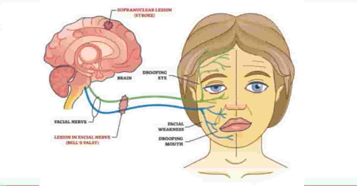 Le Paralisi Facciale Tipo e Cure: Voci dall’Esperto e Testimonianze
