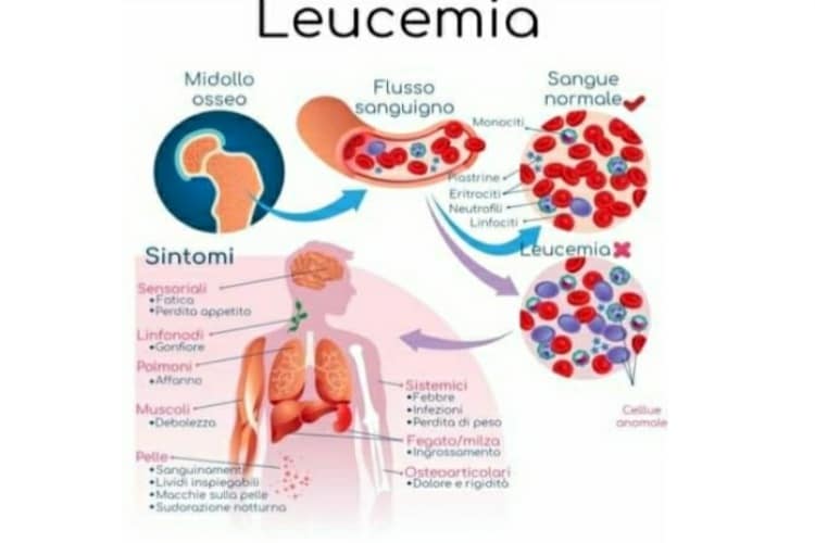 Leucemia fulminante: cause e sintomi