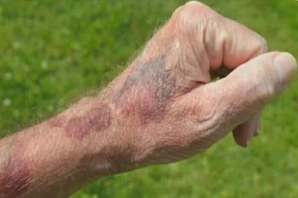 Macchie senili sulla pelle scopri cause e cure mirate