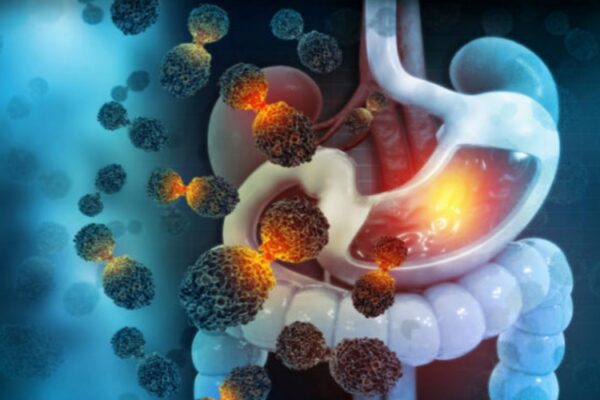 Nuovo sintomo che potrebbe cambiare la diagnosi dei tumori al colon
