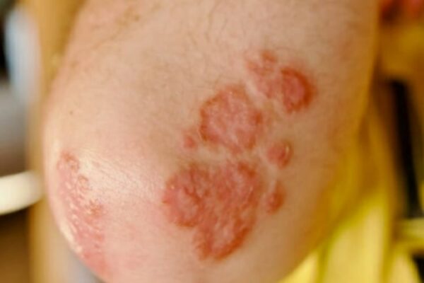 Psoriasi scopri i sintomi cure e trattamenti efficaci