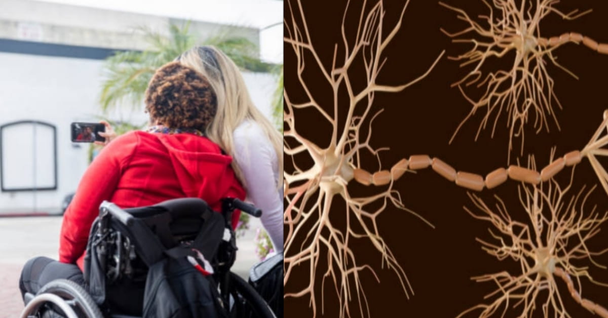 Sclerosi multipla, la svolta: scoperto il virus “silenzioso” che può scatenarla