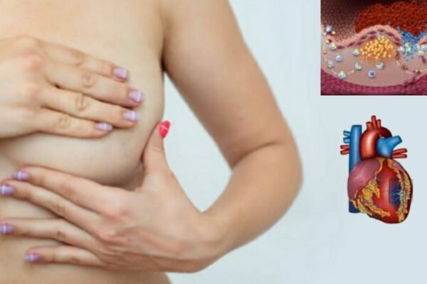 Trombosi del seno vonoso cerebrale