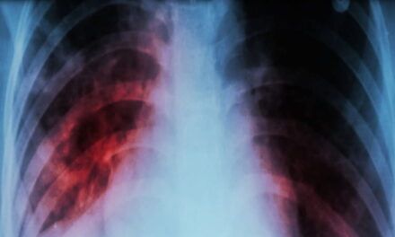 Tubercolosi, gli esperti avvertono: riconoscerla presto può salvare la vita