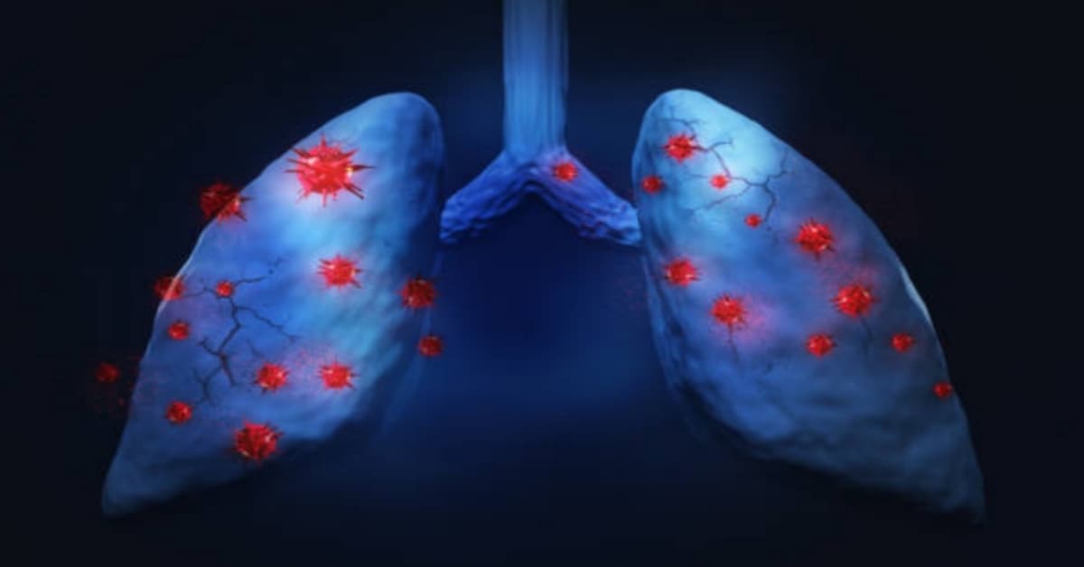 Tumore al Polmone: Descrizione della Cura, Sintomi, Dieta e Stato Critico