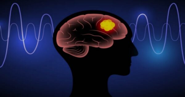 Tumore al cervello: cosa sapere davvero sul glioblastoma