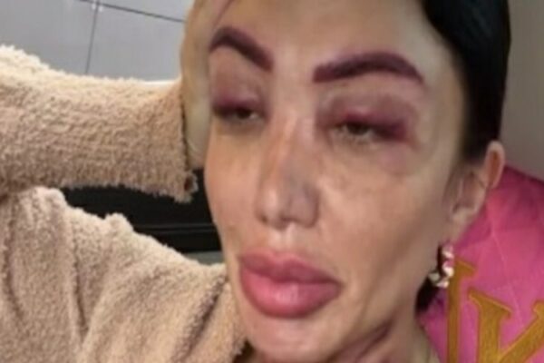 Vip devastata dalla chirurgia plastica