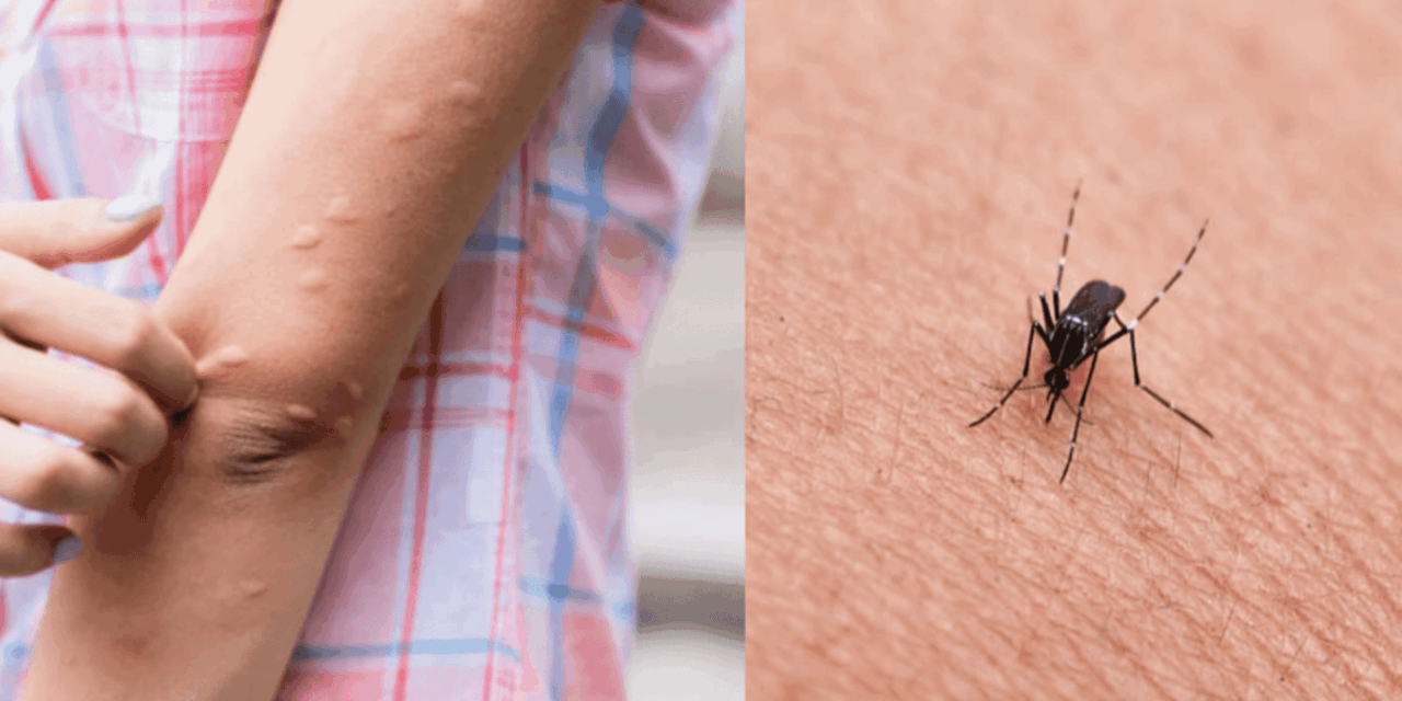 Zanzare: ecco perché alcuni persone diventano bersagli viventi e altri no