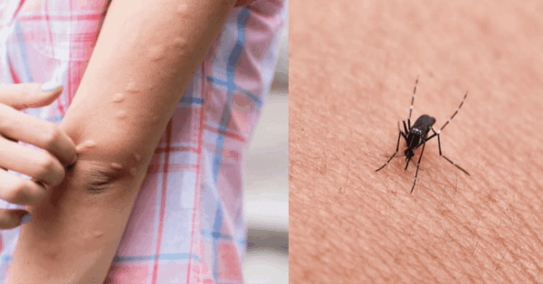 Zanzare: ecco perché alcuni persone diventano bersagli viventi e altri no